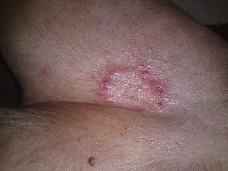 Inner Thigh Rash - Pictures, Causes, Treatment, Home ...