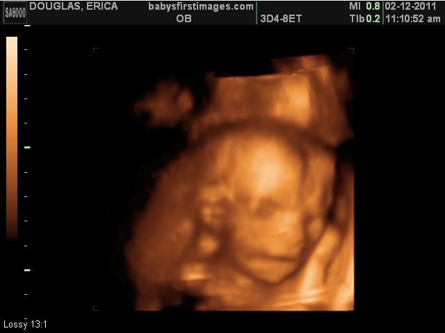 3d ultrasound pictures at 26 weeks. 3d ultrasound pictures at 26