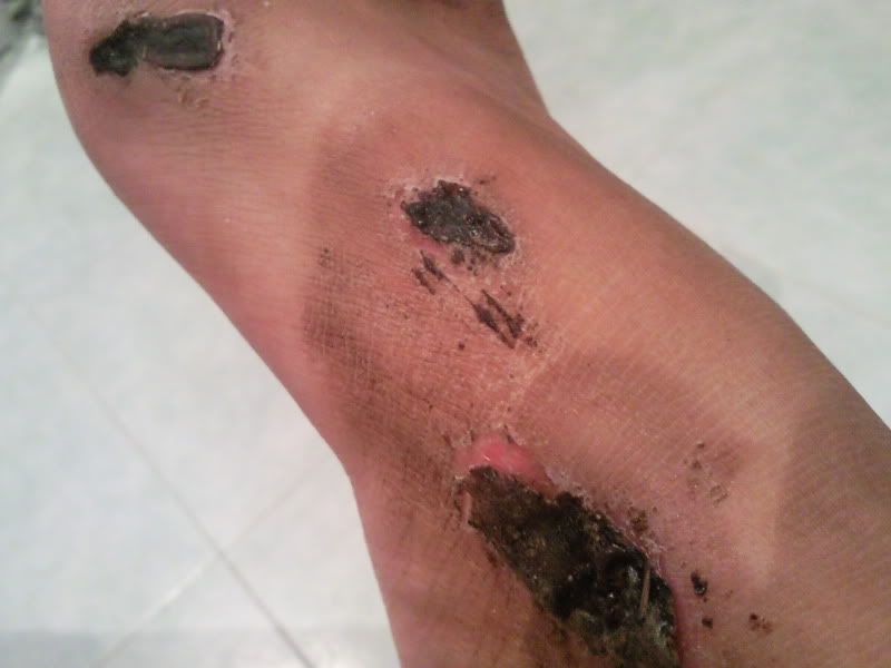 vết sẹo té xe này nên bôi cái gì, sau bao lâu thì chạy được - 1