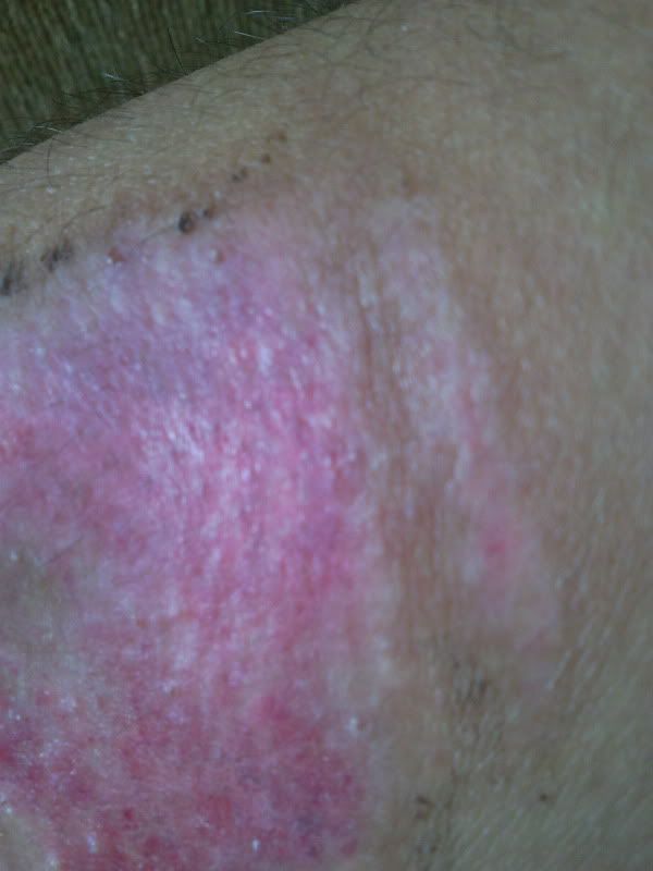 vết sẹo té xe này nên bôi cái gì, sau bao lâu thì chạy được